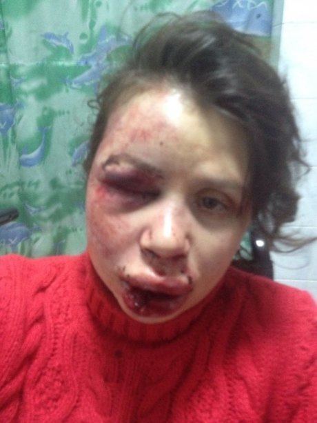 Tetiana Chornovol A Mother Of 2 Brutally Beaten And Left In Ditch Her Crime