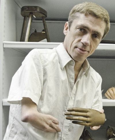 A man with a malformed hands and an artificial hand