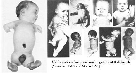 Babies born with malformations due to maternal ingestion of thalidomide