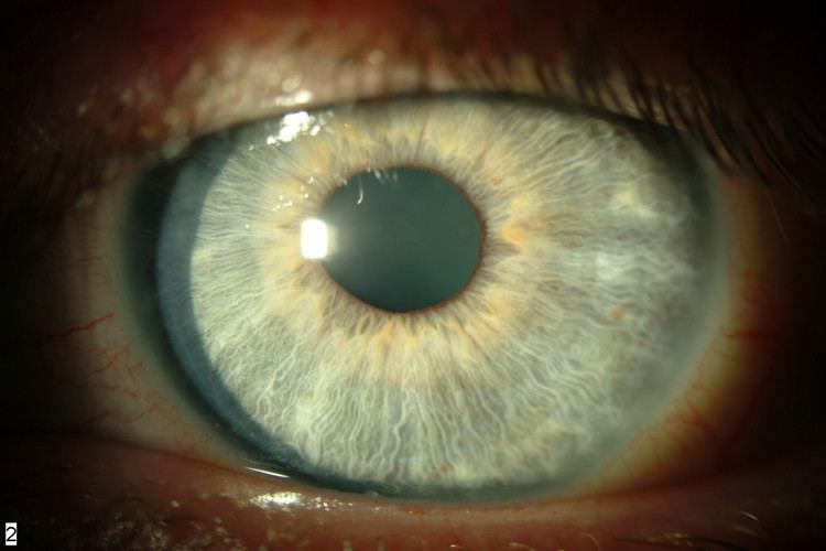 Thygeson's superficial punctate keratopathy