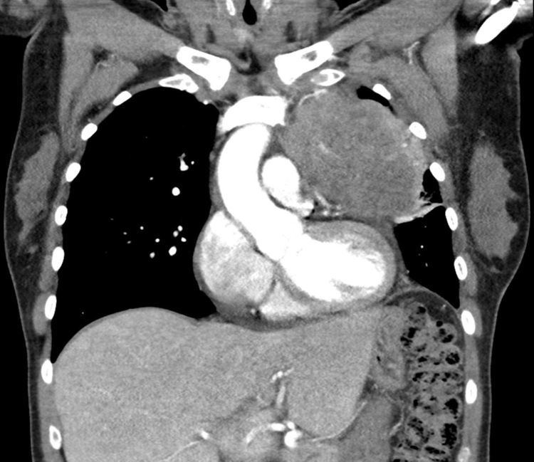 Thymic carcinoma