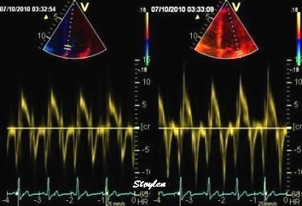 Tissue Doppler echocardiography