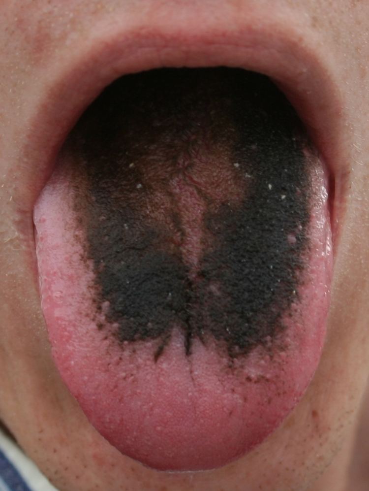 Tongue disease