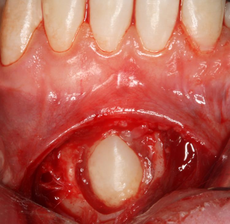 Tooth impaction
