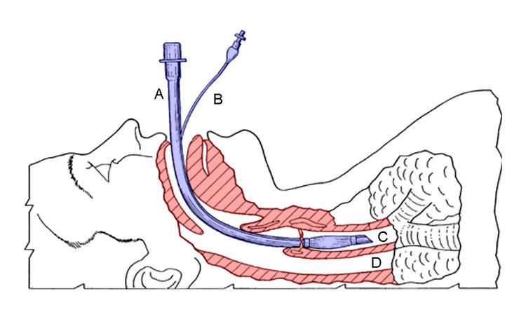 Tracheal tube