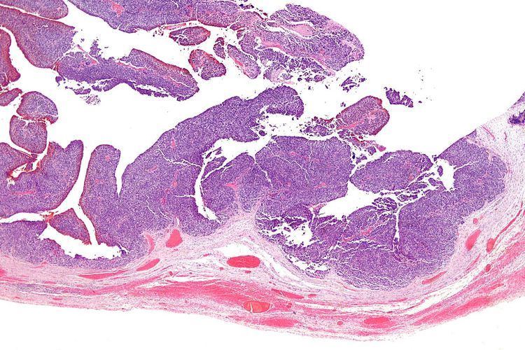 Transitional cell carcinoma of the ovary