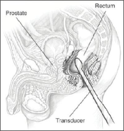 Transrectal ultrasonography