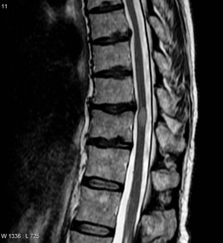 Transverse myelitis