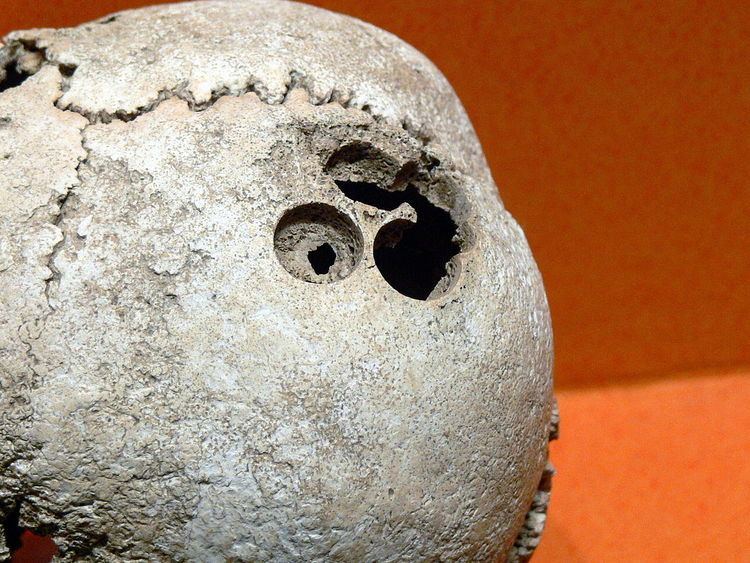 Trepanation in Mesoamerica