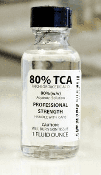 Trichloroacetic acid Trichloroacetic Acid Wart Mole Removal TCA Peel Solution