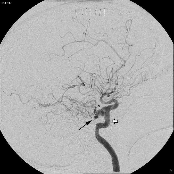 Trigeminal artery