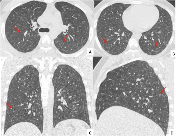 The role of HRCT in Tropical Pulmonary Eosinophilia - European Journal of  Radiology