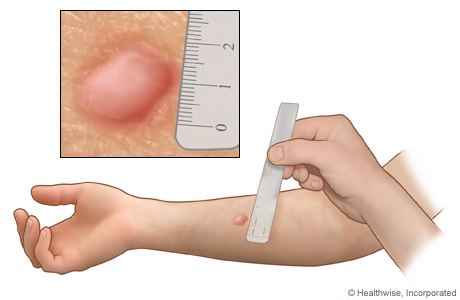 Tuberculin Measurement of a Tuberculin Skin Test Reaction