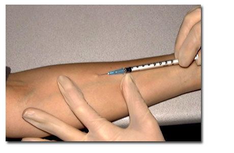 Tuberculin Mantoux Tuberculin Skin Test