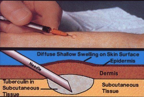 Tuberculin PPD Tuberculin Skin Testing