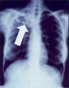 Tuberculosis radiology