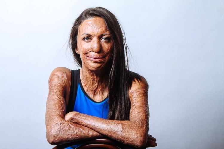 Turia Pitt Burns survivor Turia Pitt fundraises for charity and says