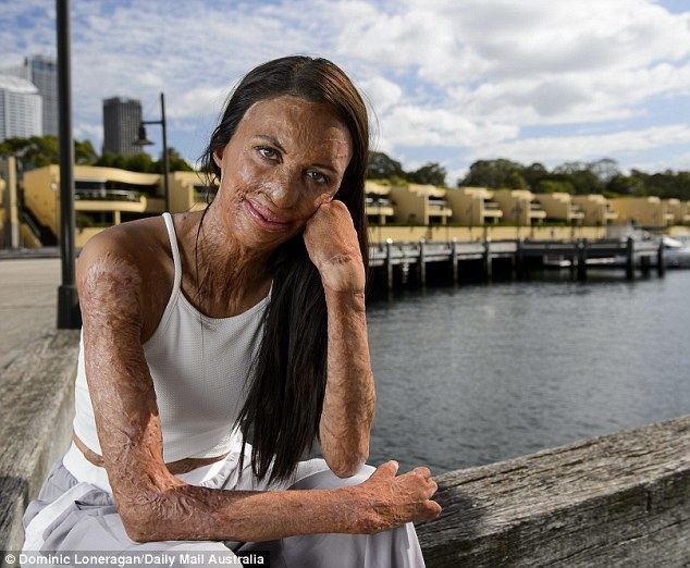 Turia Pitt Burn survivor Turia Pitt meets Laos boy SHE calls a hero