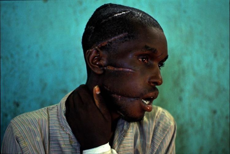 A Tutsi man with scars on his head and face.