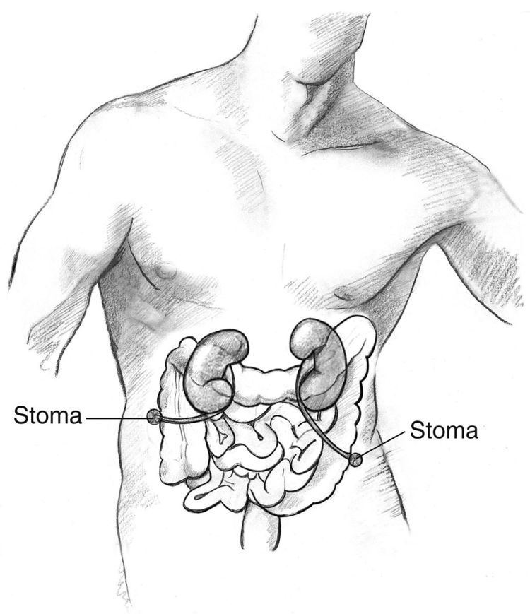 Ureterostomy