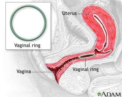 The uterus and vaginal ring