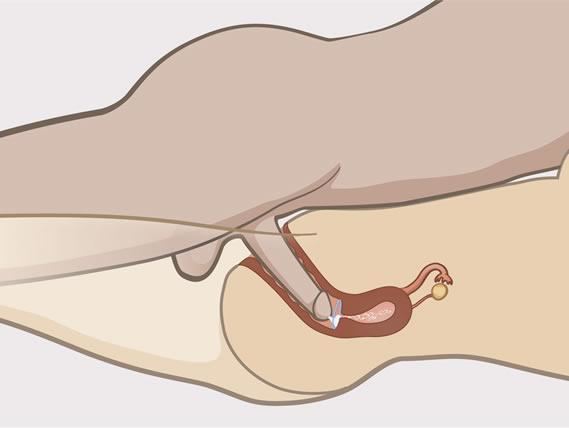 Intercourse using vaginal ring