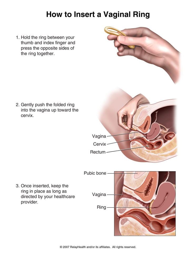 Steps on how to insert vaginal ring