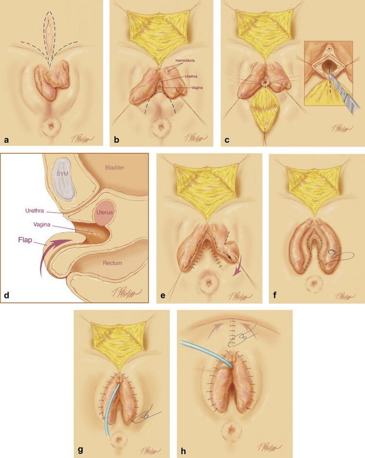 Vaginoplasty in the female exstrophy population: Outcomes and complications  - Journal of Pediatric Urology