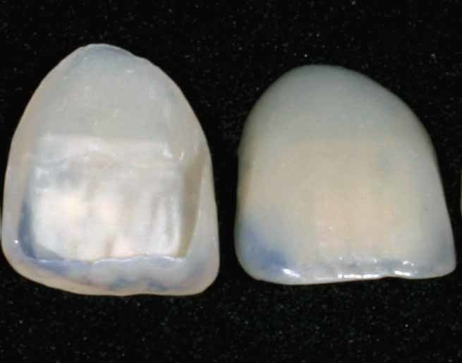 Veneer (dentistry)