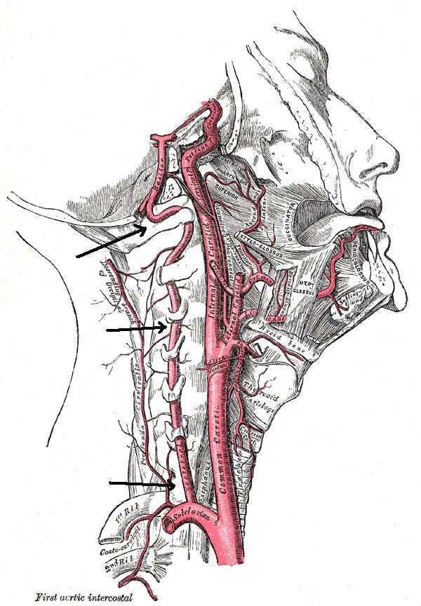 Vertebral artery dissection