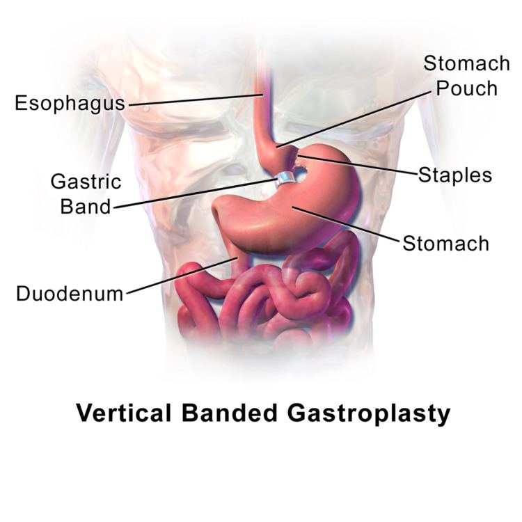 Vertical banded gastroplasty surgery