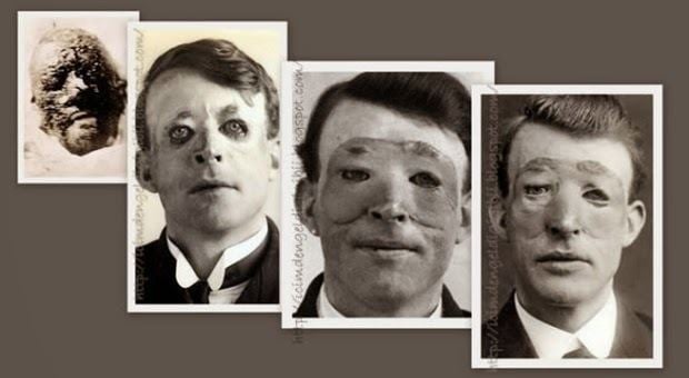 Photographs of Walter Yeo's surgery journey from left to right, Walter with terrible facial injuries. Next is Walter but with growing hair with no eyelid, then Walter during and after his successful skin flap surgery.