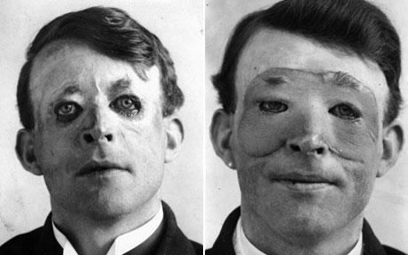 Walter Yeo before and after his advanced plastic surgery, namely skin flapping, and also believed as the first person to go under the knife for plastic surgery after he was wounded in the Battle of Jutland in 1916. A photograph showing his face after healing from surgery (left), and after the tube pedicle flap reconstruction of his face (right); where he both wearing a white collarless shirt under a black coat.