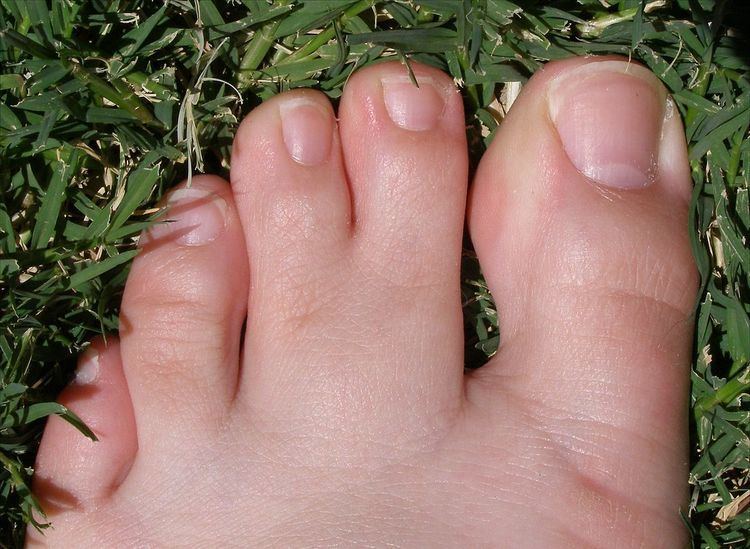 Webbed toes