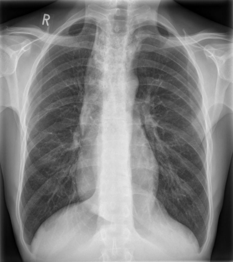 Widened mediastinum