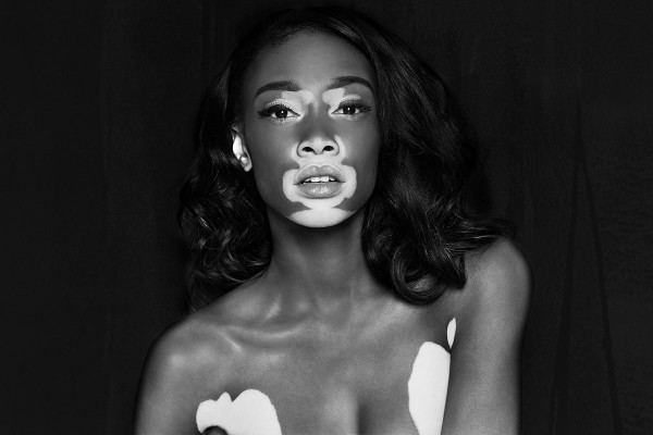 Winnie Harlow ANTM Chantelle BrownYoung on Vitiligo and Reality TV Flare