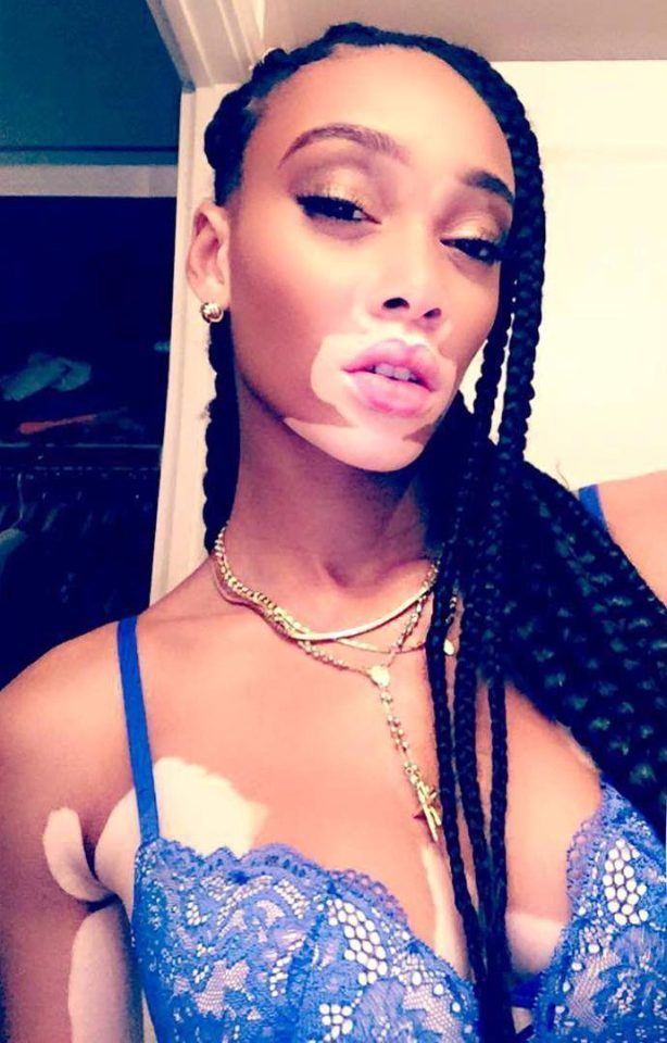 Winnie Harlow httpswwwthesuncoukwpcontentuploads20160