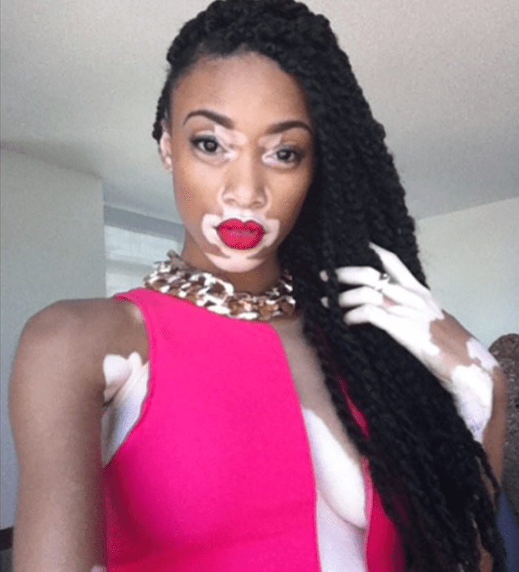 Winnie Harlow Once Bullied for Her Rare Skin Condition Chantelle BrownYoung is
