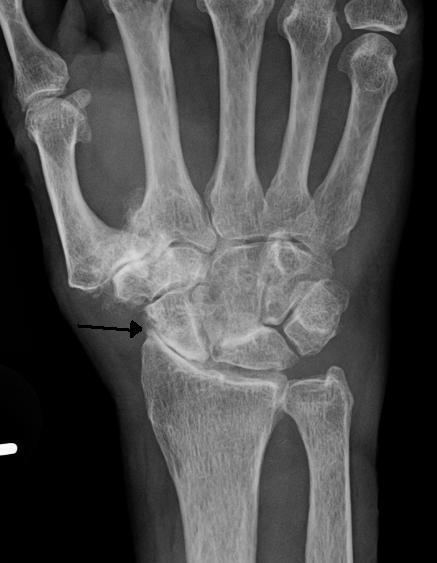 Wrist osteoarthritis