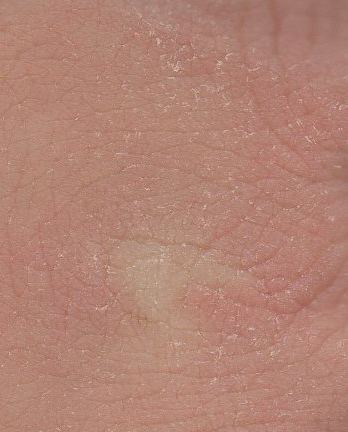 Xeroderma