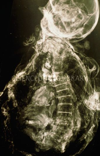 Yde Girl Xray of Yde Girl mummy showing spinal scoliosis Bog Body