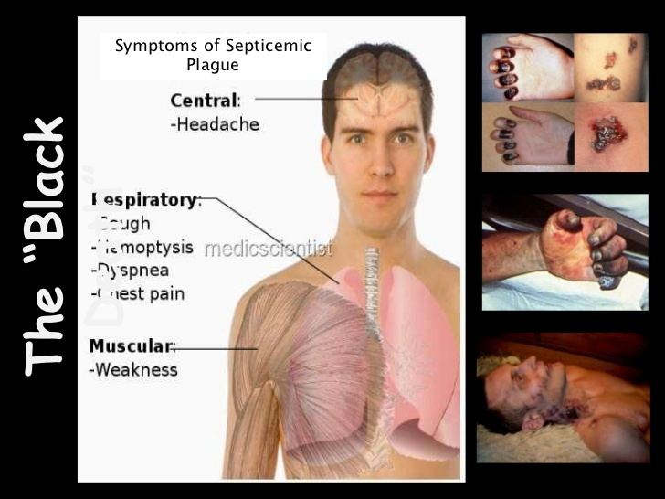 Yersinia pestis ~ Everything You Need to Know with Photos | Videos