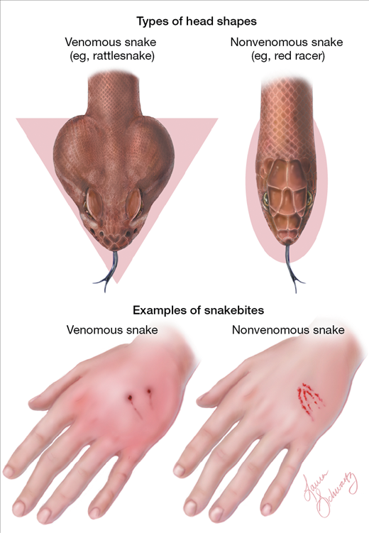 How to Treat a Snake Bite How to Treat a Snake Bite